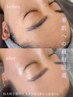 透明感アップ◎角質毛穴レスWAX顔脱毛＋高保湿パック通常11,000円