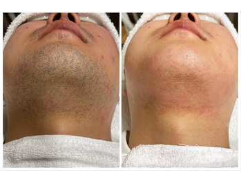 ヴァイオス 新宿店(VIOS)/◆ヒゲ脱毛【before/after】