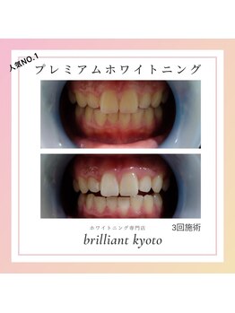 ブリリアント 京都店(Brilliant)/人気！プレミアムホワイトニング