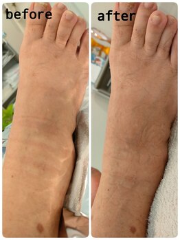 サロンドットブレスドットケイ(salon.bless.k)/フットタラソテラピー前後