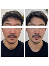 ルビーミー(Ruby's Me)/美顔筋テラボーラー症例