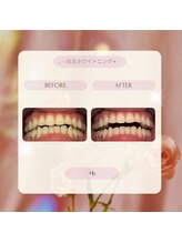 プラスビー 2号店(+b)/ホワイトニングビフォーアフター