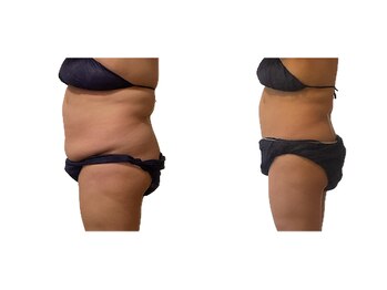 コーラル(Coral)/デトックス痩身(40代施術結果)