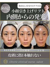 シェリー(Cherie)/たるみ改善・小顔