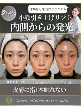 シェリー(Cherie)/【インセルダム】たるみ改善小顔