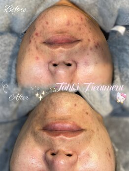 ラティーナ(Lattina)/顎ニキビ　ハーブピーリング