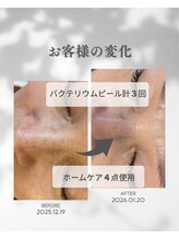 プレジール(Plaisir)/お手入れ3回・ホームケア使用