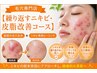 【繰り返すニキビ・皮脂改善コース】基礎の毛穴洗浄+ニキビ専用ピーリング