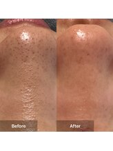 シュガープラスケイ 岩倉店(Sugar+K)&nbsp;韓国式 3D毛穴洗浄