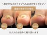【根本原因にアプローチ】巻爪ケア/1本(つらい巻爪にも対応） 11000→10000円