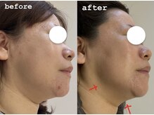 ウィ アネラ(U'i Anela)/脂肪分解