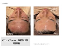 フェレザ 新潟(Felleza)/光フェイシャル女性スタッフ施術