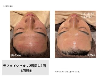 フェレザ 新潟(Felleza)/光フェイシャル女性スタッフ施術