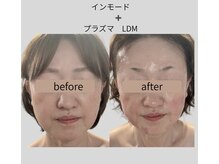 リズ(rE:S)/韓国インモードリフティング50代