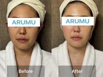 アルム コリア(ARUMU KOREA)/小顔3Dバンブーコルギ