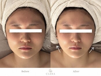 クレラ 恵比寿(CLERA)の写真/エラ張り・歪み改善に！人気No.1コース『エステ×美容鍼』で最強小顔ケア♪