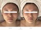 クレラ 恵比寿(CLERA)の写真/エラ張り・歪み改善に！人気No.1コース『エステ×美容鍼』で最強小顔ケア♪