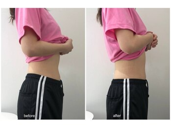 バニーヒップ(Bunny Hip)/before→after