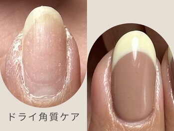 ツリー 吉祥寺店(TREE)/ドライ角質ケア