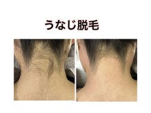 エム(M)/シュガーリング&光脱毛