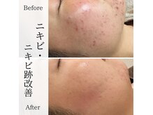 ★BeforAfter★それぞれのお悩みに沿ったメニューでお肌をケア