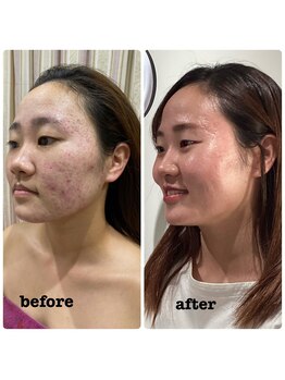 アネラ(ANERA)/小顔矯正&毛穴洗浄BeforeAfter