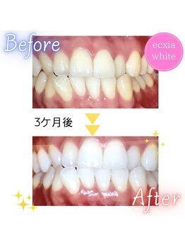 エクシアホワイト 立川南口店/セルフホワイトニング
