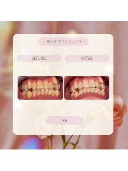プラスビー 2号店(+b)/ホワイトニングビフォーアフター