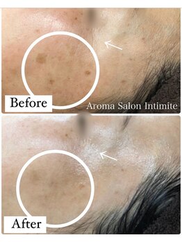 アンティミテ(Intimite)/【スキンケアコース】1年の変化