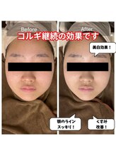 チョアチョア 札幌すすきの店(CHOA-CHOA)/石膏パックでくすみ改善♪