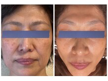 エヌプラスビューティー(N+beauty)/半年の変化