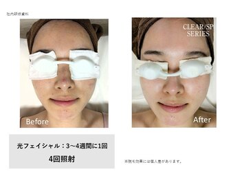 フェレザ 新潟(Felleza)/光フェイシャル女性スタッフ施術