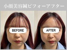 フラット(flat)/小顔美容鍼ビフォーアフター