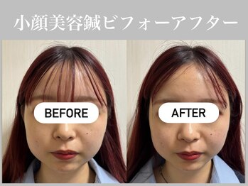 フラット(flat)/小顔美容鍼ビフォーアフター