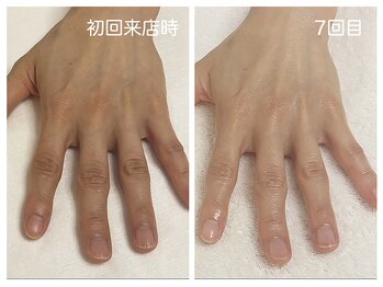 キレイテ 福岡天神店/ゴツゴツ感とハリのなさ