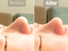 ボーンオム(Born Homme)/毛穴洗浄＋美容液導入：20代女性