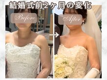 マリスステラ 天王寺(MarisStella)/ブライダルエステ2ヶ月の変化！