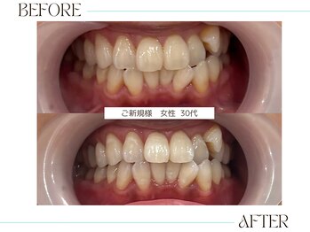 ホワイトニングサロンブライト 尼崎店(Whitening salon bright)/今がオススメホワイトニング時期