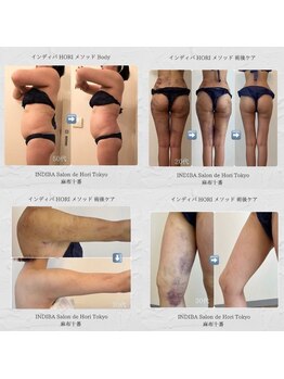 インディバ ホリ ナゴヤ ハニーズビューティー(INDIBA HORI NAGOYA Honey’s beauty)/名古屋インディバ