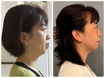 カナエルサロン 旭川(KANAERU SALON)/【小顔ケア】症例☆