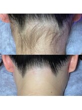 キラディ(KILADY)/1回2000円～うなじデザイン脱毛