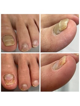 肥厚爪ケア