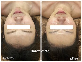 サロンディト(ditto)/施術9回*小顔コルギ/マーメイド