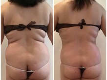 ビューティーマックス(Beauty Max)/痩身　before→after 1ヶ月後