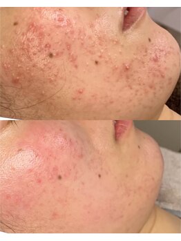 サロンドレヴ(salon de LaEv)/ニキビ