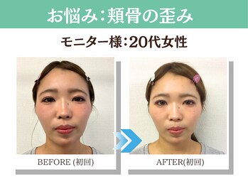 ナチュラルパーフェクトフェイス 新宿/ビフォーアフター写真