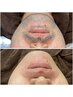 【男の肌革命】匠道フェイシャルWAX◆青髭、毛穴レスで好印象フェイスへ