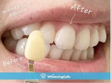 ホワイトニングカフェ 豊中店(WhiteningCafe)/◎歯のホワイトニング施術写真◎