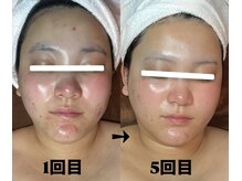 パーフェクトボディ(PERFECT BODY)/赤み・ニキビ、根本からケア