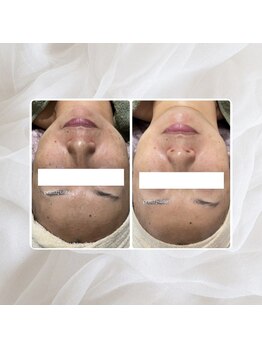 プリマプリート 名駅店/水玉×スノーピール